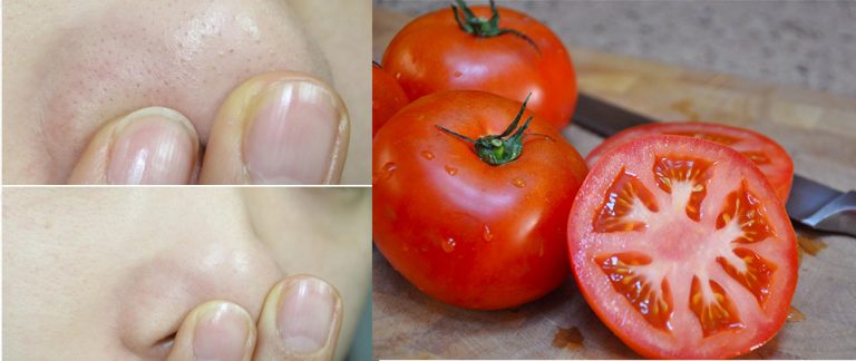 Cách trị mụn cám bằng cà chua hiệu quả và đẹp da 2